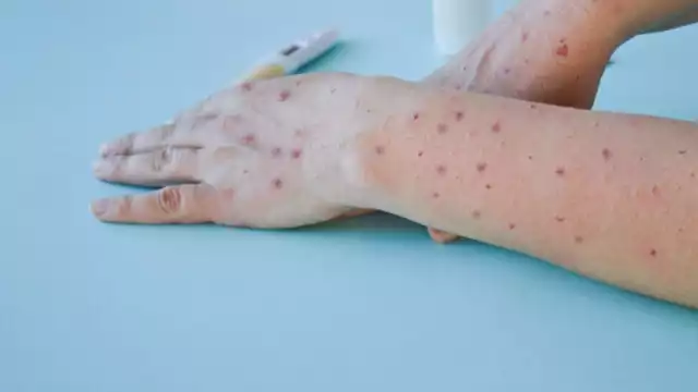 La CDMX es la entidad federativa con más casos de esta enfermedad endémica en África