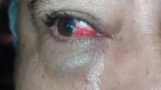 El suegro de la denunciante, un hombre mayor puede perder la visión debido a que le desprendieron la retina durante la golpiza policial