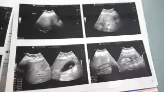 Paciente con cálculos en la vesícula enfrenta omisiones y falta de atención en el ISSSTE