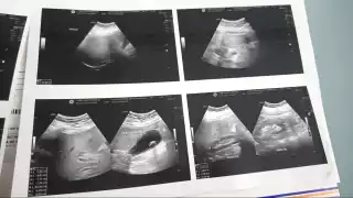 Ciudadana denuncia negligencia médica en clínica del Issste en Chetumal