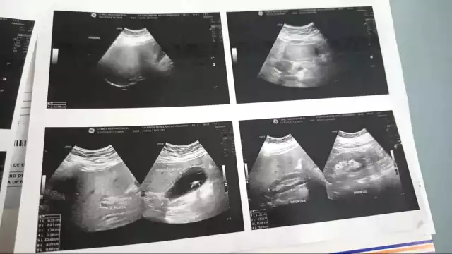 Paciente con cálculos en la vesícula enfrenta omisiones y falta de atención en el ISSSTE