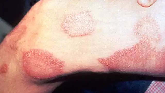 Hasta el último reporte se han contabilizado dos casos en hombres. Foto: Internet