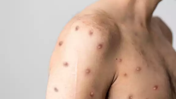 El hombre actualmente se encuentra estable y bajo tratamiento por el VIH El hombre actualmente se encuentra estable y bajo tratamiento por el VIH