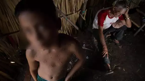 La varicela se presenta de 10 a 21 días después de la exposición al virus y, dura entre cinco y 10 días.