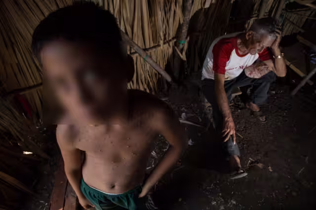 La varicela se presenta de 10 a 21 días después de la exposición al virus y, dura entre cinco y 10 días.