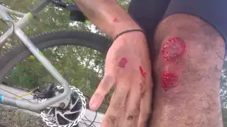 Joven yucateco termina lesionado tras ser derribado en su bicicleta por un corredor