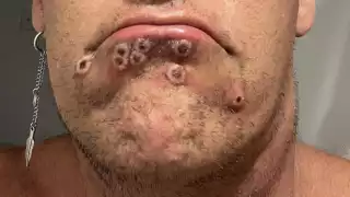 Durango, el único estado sin contagiados por viruela de mono