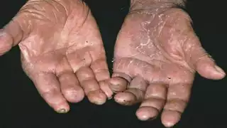 La lepra es una enfermedad muy estigmatizada en todo el mundo