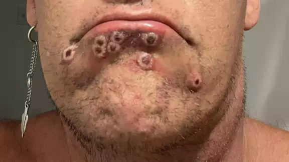 El aumento de contagios de la viruela del mono en Quintana Roo se dio a conocer este 6 de septiembre por medio de la SSA El aumento de contagios de la viruela del mono en Quintana Roo se dio a conocer este 6 de septiembre por medio de la SSA