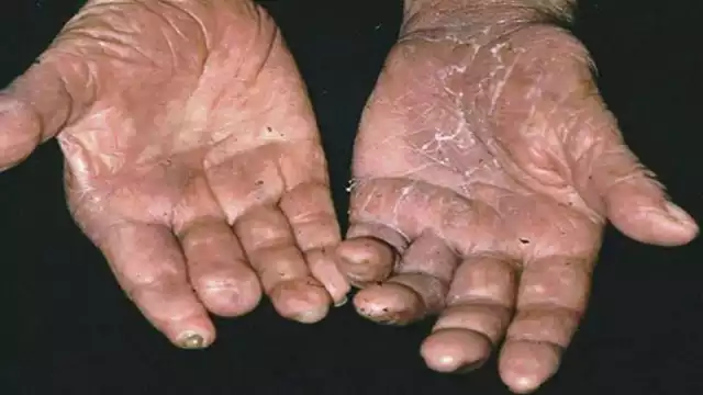 La lepra es una enfermedad muy estigmatizada en todo el mundo