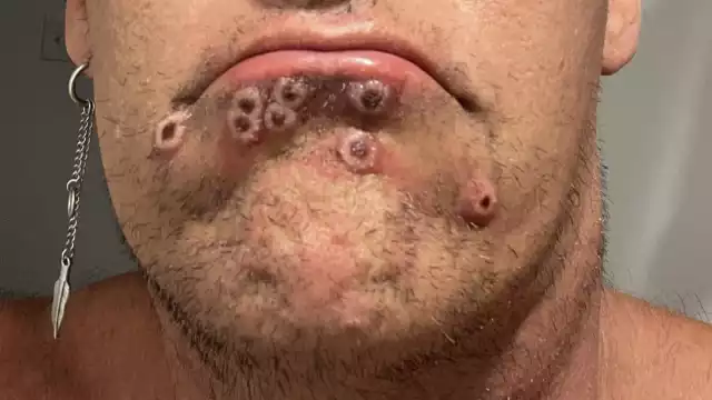 Durango, el único estado sin contagiados por viruela de mono