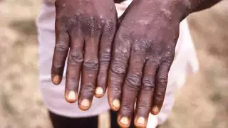 La viruela de mono se ha esparcido por Estados Unidos