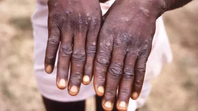 La viruela de mono se ha esparcido por Estados Unidos