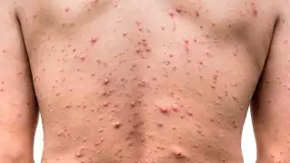 La viruela del mono llegó a Quintana Roo el pasado 18 de julio, cuando se confirmó que el primer caso se encontraba internado en el Hospital General de Chetumal