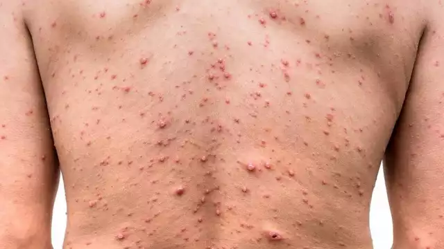 El último caso fue publicado apenas en la plataforma nacional el día de ayer que se hace un corte, expuso la funcionaria