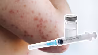 Sarampión en Campeche: dónde vacunarse y quiénes deben aplicarse la dosis en 2026