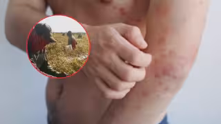 Confirman cuarto caso de sarampión en Campeche en 2026; es jornalero de Candelaria