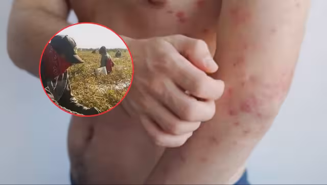 Confirman cuarto caso de sarampión en Campeche. Se trata de un jornalero de Candelaria que se contagió en Chiapas.