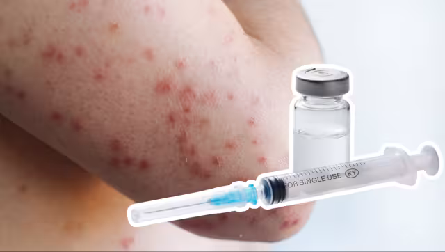 Se han confirmado 14 casos de sarampión en Campeche desde 2025 y no hay nuevos contagios en 2026.