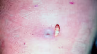 Suben a cinco los casos de miasis por Gusano Barrenador en Campeche; nuevo contagio en Hopelchén