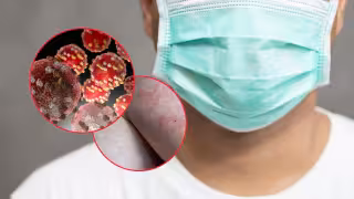 Cómo se contagian los campechanos de sarampión y por qué el cubrebocas podría ayudar