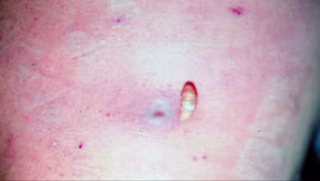 Suben a cinco los casos de Gusano Barrenador en humanos en Campeche. El paciente es un hombre de 86 años del municipio de Hopelchén, con lesiones cutáneas en el brazo izquierdo.