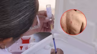 Confirman 9 casos de sarampión en Campeche durante 2026; Salud federal mantiene vigilancia