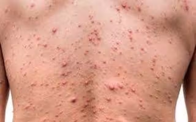 Los enfermos al parecer no presentan complicaciones