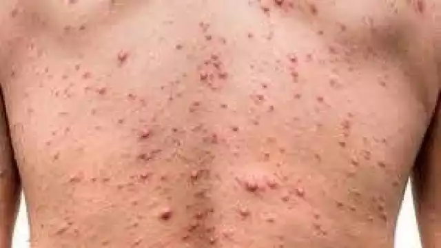 Se informó la situación actual de Salud dejando saber que en ambulatorio son 31 casos