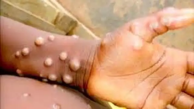 La Viruela del Mono es común en África. Foto: Especial