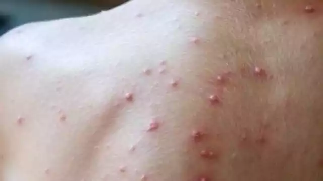 Descarta SSA casos sospechosos de viruela de mono en Campeche