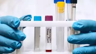 Rusia ha detectado su primer caso de viruela del mono, según confirmó la autoridad sanitaria Rospotrebnadzor.