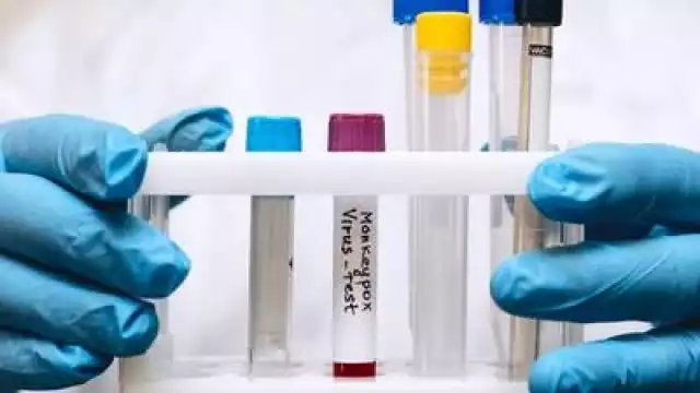 Rusia ha detectado su primer caso de viruela del mono, según confirmó la autoridad sanitaria Rospotrebnadzor.