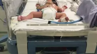 Los bebés tienen síntomas como dolor, tos, fiebre mayor a 39 grados e irritación de garganta; otros son diarrea y vómito