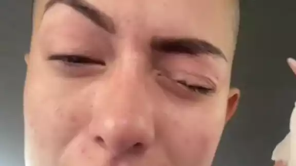 La joven muestra su ojos pegado con Kola loka