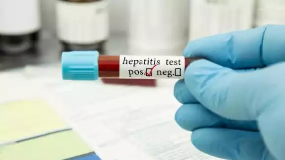 Tamaulipas analiza el primer caso de hepatitis infantil en México Tamaulipas analiza el primer caso de hepatitis infantil en México
