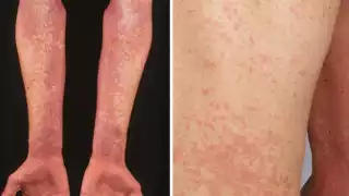 Quintana Roo tiene la cifra más alta del sureste mexicano en casos la ‘Fiebre Escarlata’ en menores de 5 a 15 años de edad