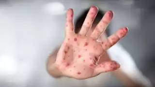 La viruela del mono está relacionada con la viruela, pero es mucho menos grave