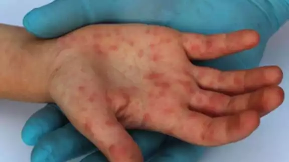Europa ha presentado más casos de viruela del mono en el mundo