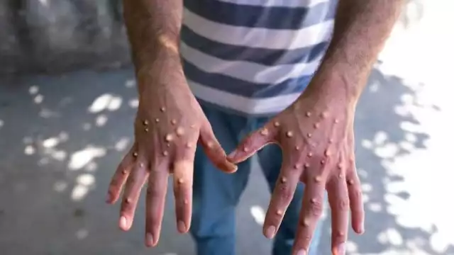 A nivel peninsular, el Estado supera a Yucatán, que ayer reportó 137 contagios y Campeche 11