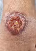 Incremento de 1175% en leishmaniasis cutánea