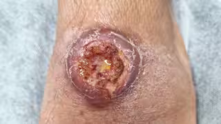 Escala leishmaniasis en Campeche: registra 51 casos en 2026