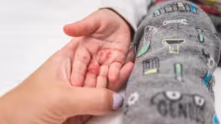 Casos de sarampión en México se mantienen activos: Salud refuerza vacunación en Jalisco y anuncia acciones en transporte público