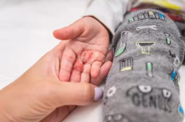 El secretario de Salud insistió en que la vacunación sigue siendo la única estrategia efectiva para frenar la propagación del sarampión