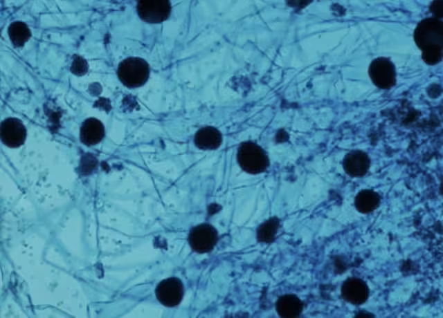 Los principales síntomas suelen ser congestión y sangrado nasal. También se puede presentar hinchazón y dolor en el ojo