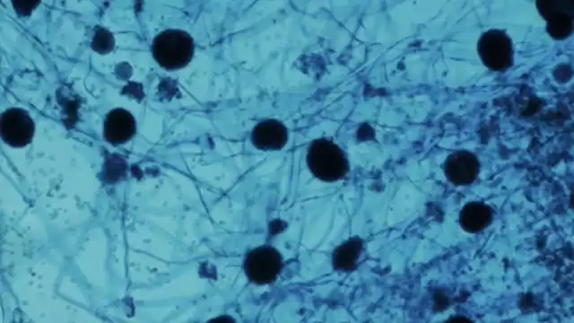 Los principales síntomas suelen ser congestión y sangrado nasal. También se puede presentar hinchazón y dolor en el ojo