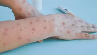 Es necesario mantener medidas preventivas como lavado frecuente de manos con agua y jabón y uso correcto de cubrebocas