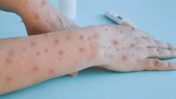 Es necesario mantener medidas preventivas como lavado frecuente de manos con agua y jabón y uso correcto de cubrebocas Es necesario mantener medidas preventivas como lavado frecuente de manos con agua y jabón y uso correcto de cubrebocas