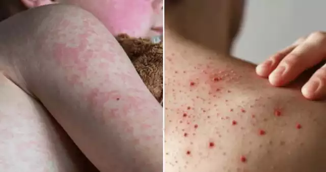 Los casos de sarampión han ido en aumento en el país.