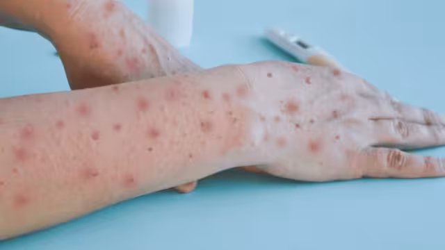 Es necesario mantener medidas preventivas como lavado frecuente de manos con agua y jabón y uso correcto de cubrebocas